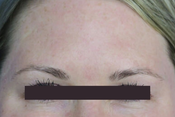 After treatment: Before and After Botox - Female - Crows Feet - Milwaukee, WI