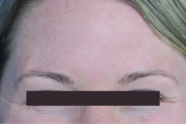 Before treatment: Before and After Botox - Female - Crows Feet - Milwaukee, WI