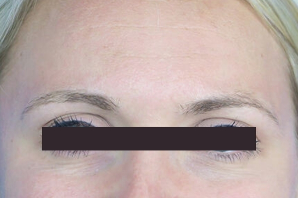 After treatment: Before and After Botox - Female - Crows Feet - Waukesha, WI