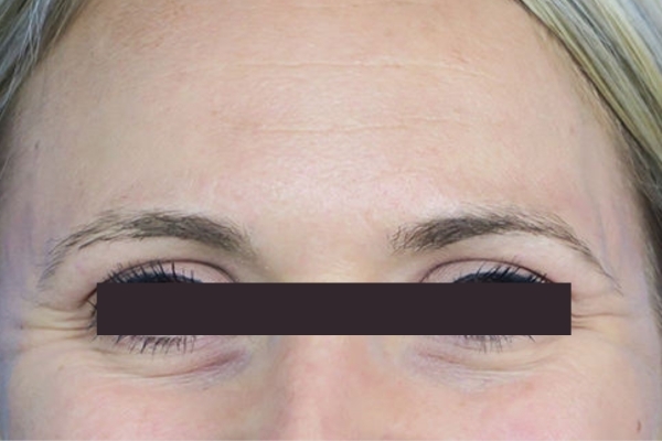 Before treatment: Before and After Botox - Female - Crows Feet - Waukesha, WI