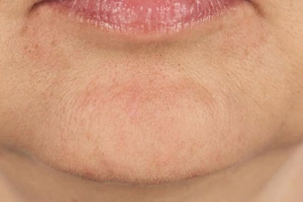After treatment: Before and After Botox - Female - Dao Chin - Brookfield, WI