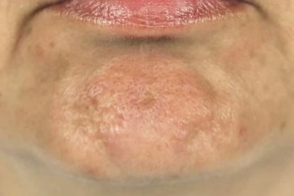 Before treatment: Before and After Botox - Female - Dao Chin - Brookfield, WI