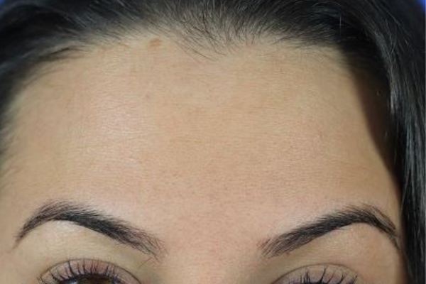 After treatment: Before and After Botox - Female - Forehead - Brookfield, WI