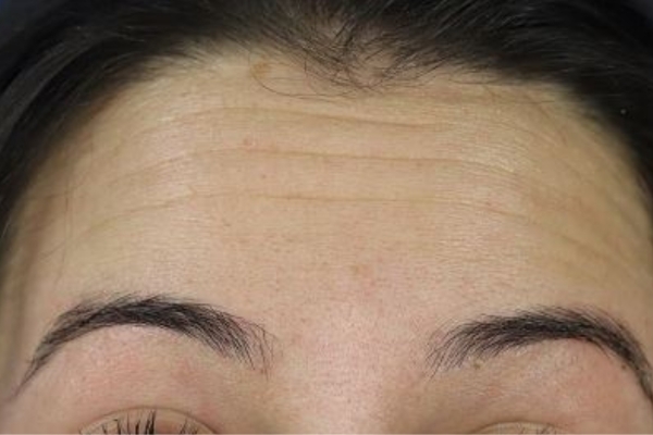 Before treatment: Before and After Botox - Female - Forehead - Brookfield, WI