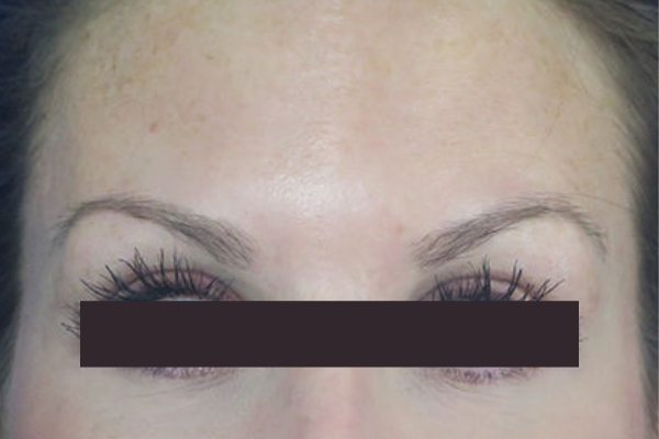 After treatment: Before and After Botox - Female - Forehead - New Berlin, WI