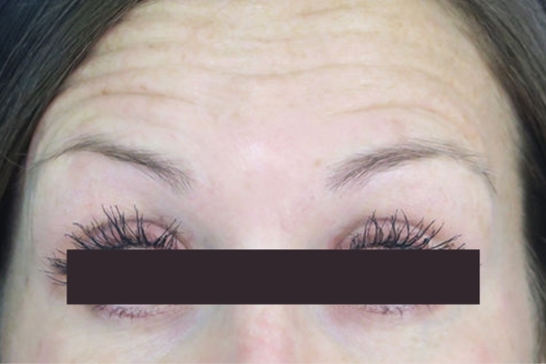 Before treatment: Before and After Botox - Female - Forehead - New Berlin, WI