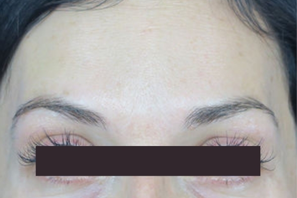 After treatment: Before and After Botox - Female - Forehead - Waukesha, WI