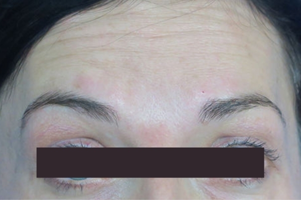 Before treatment: Before and After Botox - Female - Forehead - Waukesha, WI