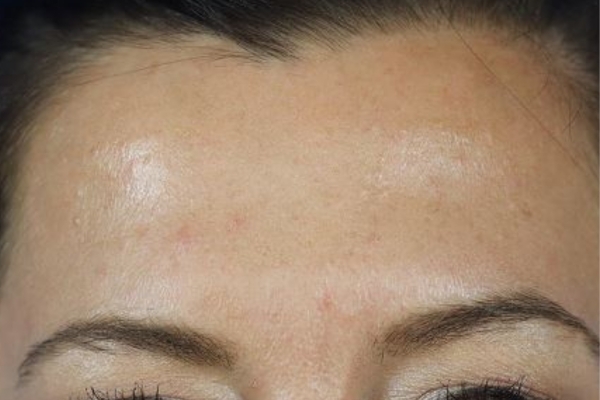 After treatment: Before and After Botox - Female - Frown Lines - Brookfield, WI
