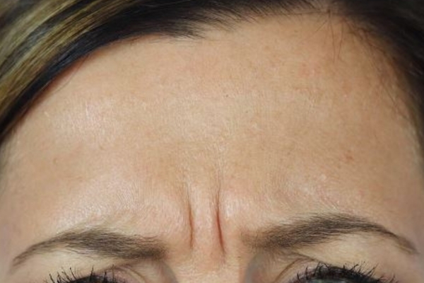 Before treatment: Before and After Botox - Female - Frown Lines - Brookfield, WI