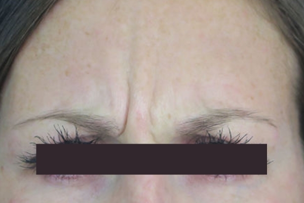 Before treatment: Before and After Botox - Female - Frown Lines - Hales Corners, WI