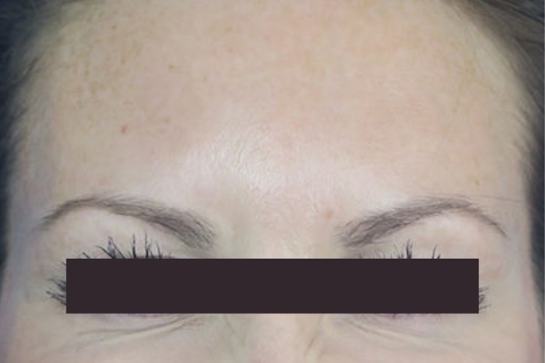 After treatment: Before and After Botox - Female - Frown Lines - Hales Corners, WI