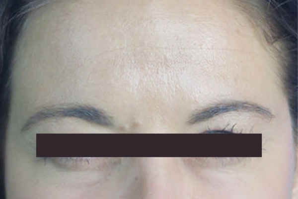After treatment: Before and After Botox - Female - Frown Lines - Milwaukee, WI