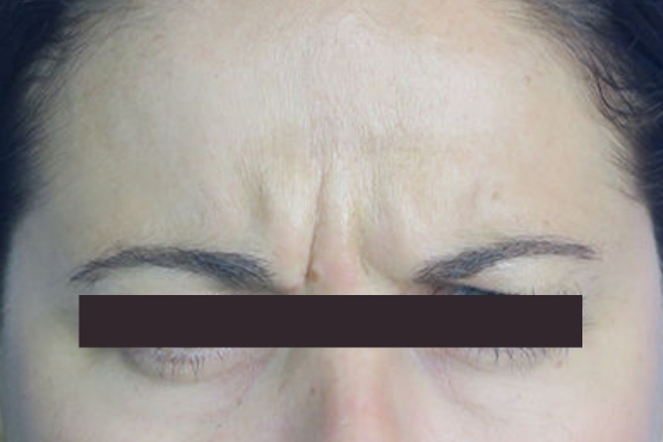 Before treatment: Before and After Botox - Female - Frown Lines - Milwaukee, WI