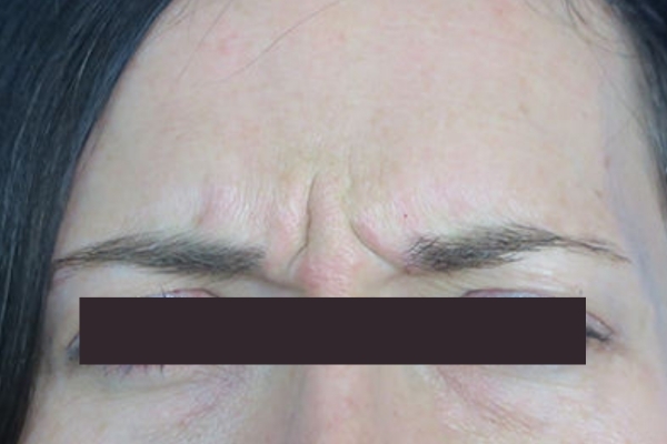 Before treatment: Before and After Botox - Female - Frown Lines - New Berlin, WI