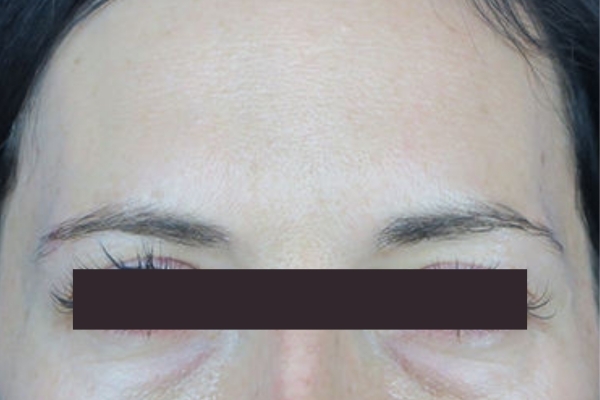After treatment: Before and After Botox - Female - Frown Lines - New Berlin, WI