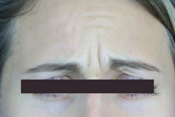 Before treatment: Before and After Botox - Female - Frown Lines - Pewaukee, WI