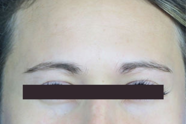 After treatment: Before and After Botox - Female - Frown Lines - Pewaukee, WI
