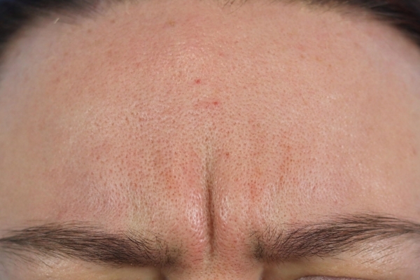 Before treatment: Before and After Botox - Female - Frown Lines - Waukesha, WI