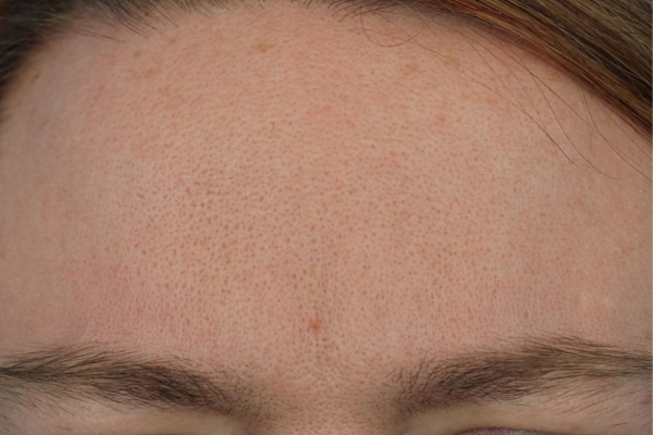After treatment: Before and After Botox - Female - Frown Lines - Waukesha, WI