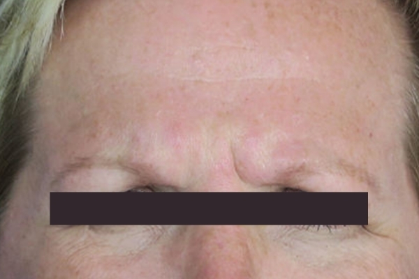 Before treatment: Before and After Botox - Female - Frown Lines - Wauwatosa, WI