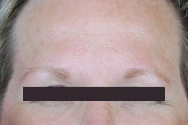 After treatment: Before and After Botox - Female - Frown Lines - Wauwatosa, WI