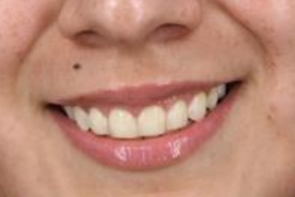 After treatment: Before and After Botox - Female - Gummy Smile - Brookfield, WI
