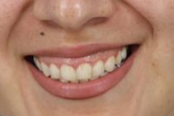 Before treatment: Before and After Botox - Female - Gummy Smile - Brookfield, WI