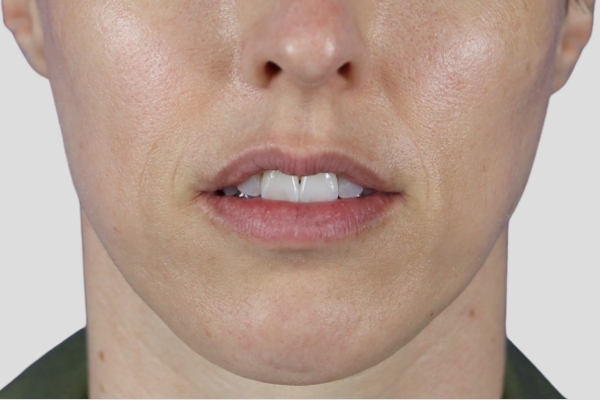 After treatment: Before and After Botox - Female - Jaw Masseter - Brookfield, WI