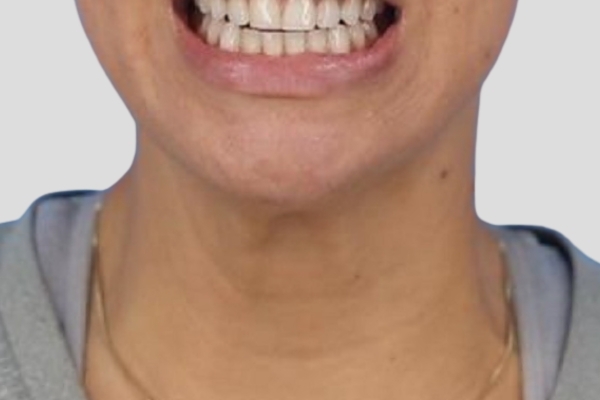 After treatment: Before and After Botox - Female - Platysma Bands Neck - Brookfield, WI