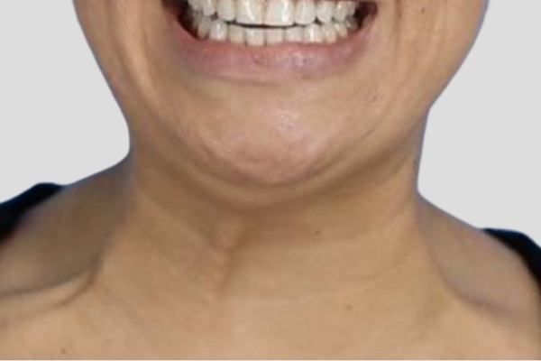 Before treatment: Before and After Botox - Female - Platysma Bands Neck - Brookfield, WI