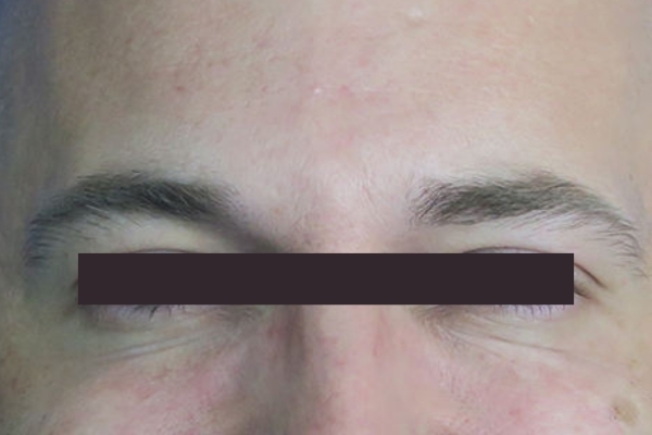 After treatment: Before and After Botox - Male - Crows Feet - Brookfield, WI