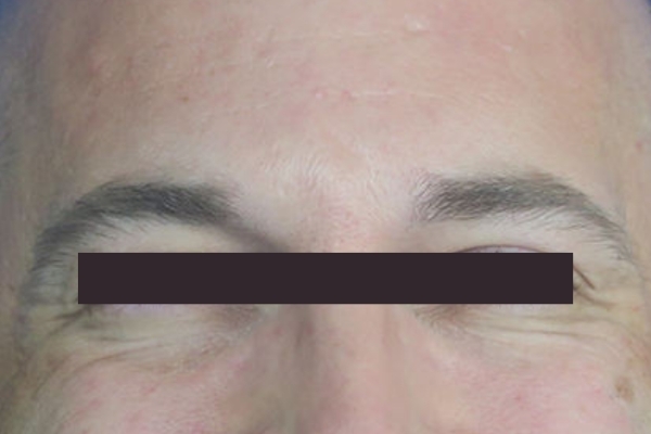 Before treatment: Before and After Botox - Male - Crows Feet - Brookfield, WI