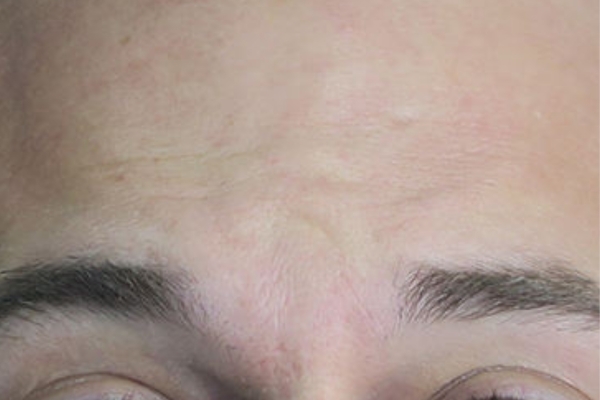 After treatment: Before and After Botox - Male - Forehead - Brookfield, WI