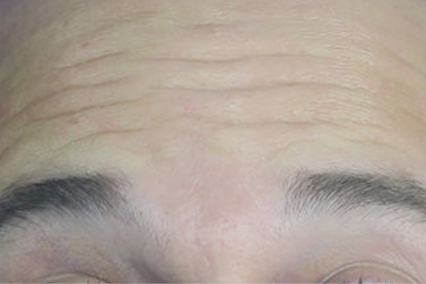 Before treatment: Before and After Botox - Male - Forehead - Brookfield, WI