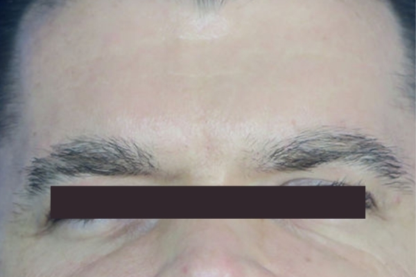 After treatment: Before and After Botox - Male - Frown Lines - Brookfield, WI