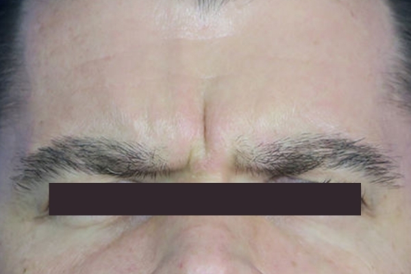 Before treatment: Before and After Botox - Male - Frown Lines - Brookfield, WI