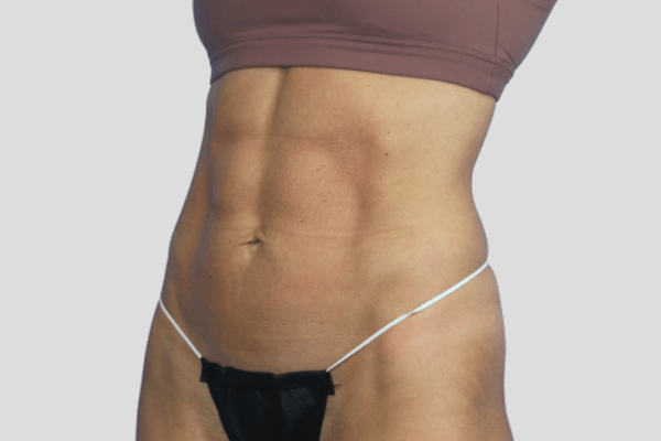 After treatment: Before and After CoolTone - Abdomen - Brookfield, WI
