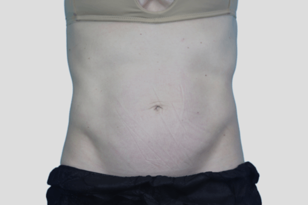 After treatment: Before and After CoolTone - Abdomen - Milwaukee, WI
