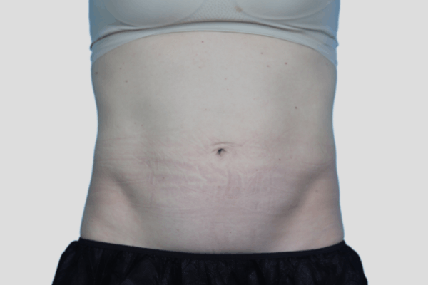 Before treatment: Before and After CoolTone - Abdomen - Milwaukee, WI