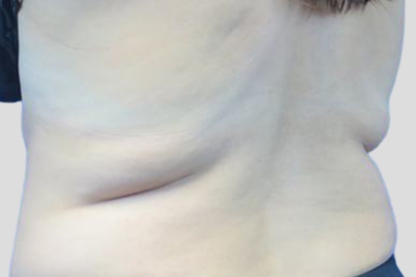 Before treatment: Before and After CoolSculpting - Back Fat - Brookfield, WI