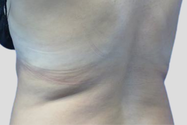 After treatment: Before and After CoolSculpting - Back Fat - Brookfield, WI