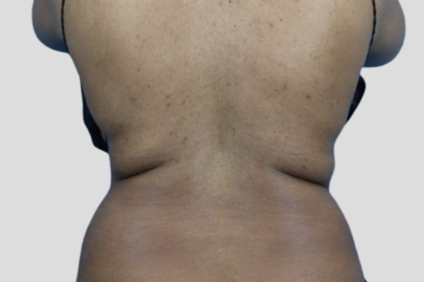 Before treatment: Before and After CoolSculpting - Back Fat - Milwaukee, WI