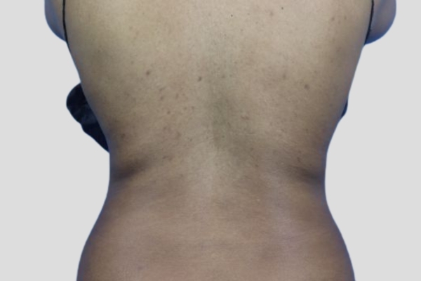 After treatment: Before and After CoolSculpting - Back Fat - Milwaukee, WI