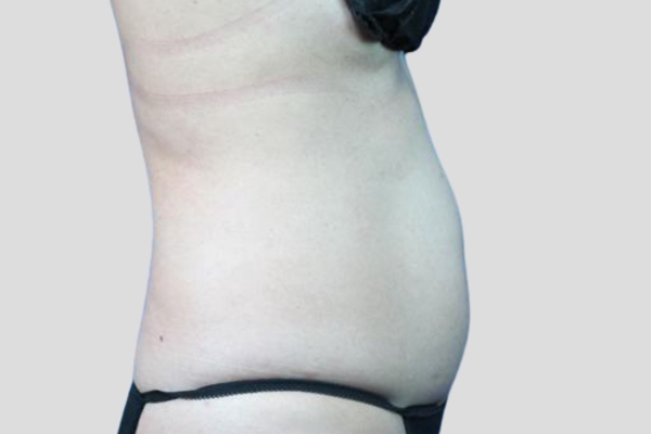 Before treatment: Before and After CoolSculpting - Stomach Fat Female Abdomen - Brookfield, WI