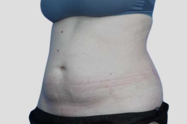 After treatment: Before and After CoolSculpting - Female Abdomen Stomach Fat - Milwaukee, WI