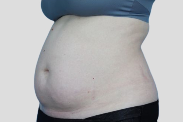 Before treatment: Before and After CoolSculpting - Female Abdomen Stomach Fat - Milwaukee, WI