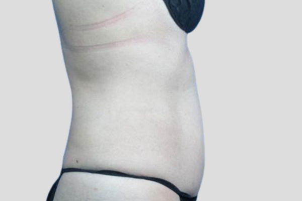 After treatment: Before and After CoolSculpting - Stomach Fat Female Abdomen - Brookfield, WI