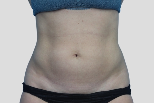 After treatment: Before and After CoolSculpting - Belly Pooch Female Abdomen - Brookfield, WI