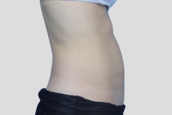 After treatment: Before and After CoolSculpting - Female Lower Abdomen Belly Pooch - Milwaukee,WI